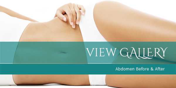 Abdominoplasty, or “Tummy Tuck