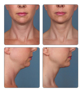 Kybella Before and After