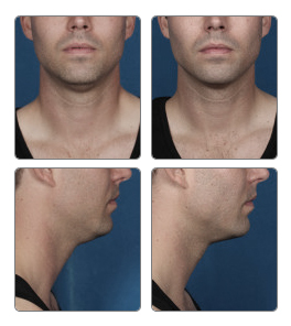 Kybella Before and After