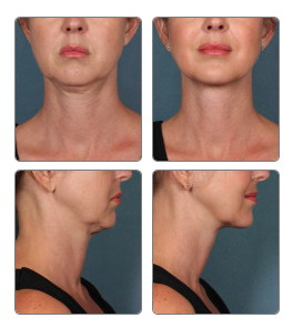 Kybella Before and After