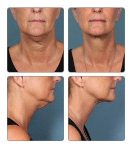 Kybella Before and After