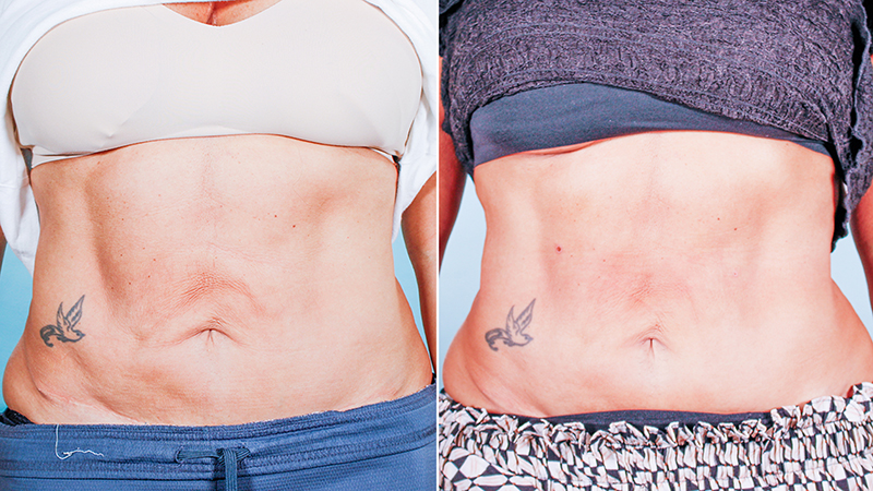attiva-abdomen